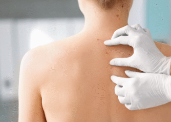 Melanoma in crescita: al TMC la prevenzione diventa priorità
